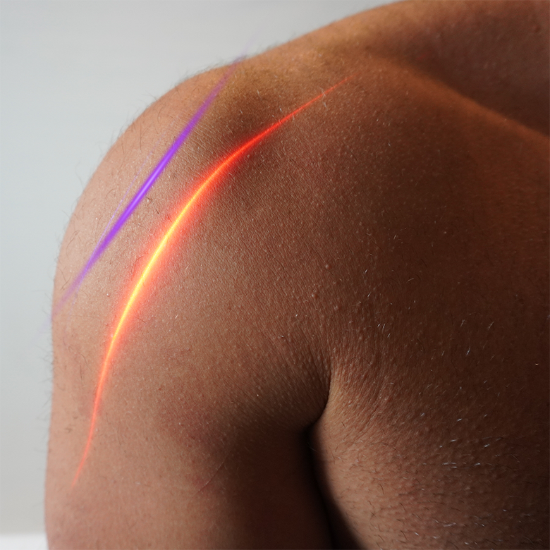 EVRL Laser in use during a clinical treatment session