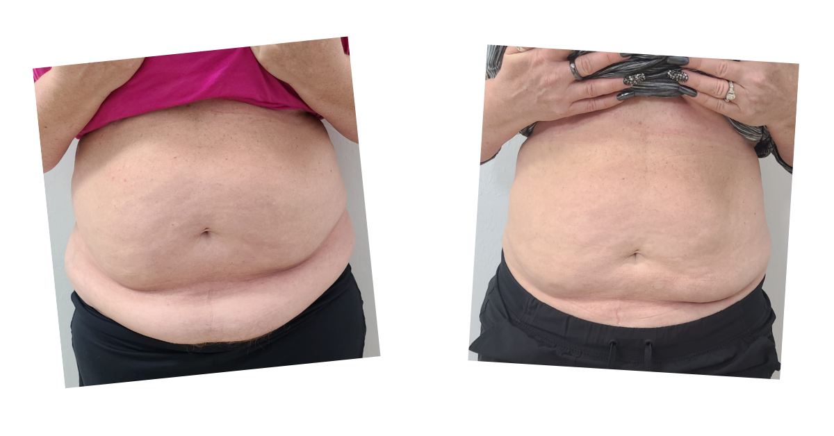 Abdomen — anterior view — before and after Emerald Laser treatment