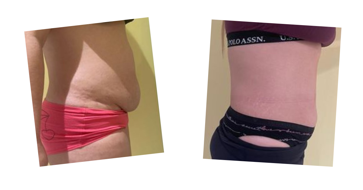 Abdomen — lateral view — before and after Emerald Laser treatment