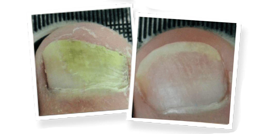 Before and after Lunula laser treatment photos of a toenail affected by onychomycosis
