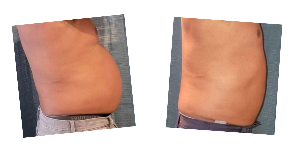 Abdomen — lateral view — before and after Emerald Laser treatment