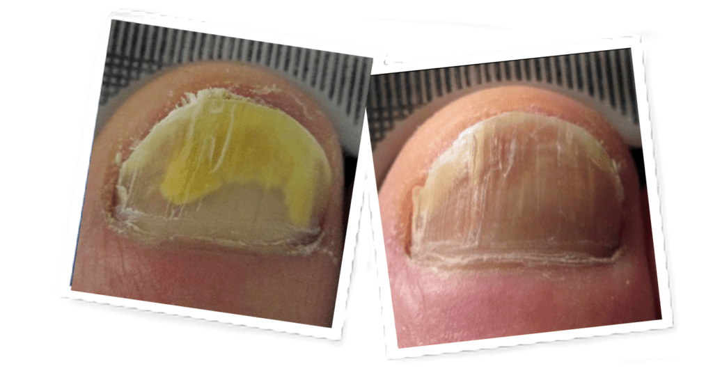 Second before and after Lunula laser treatment comparison of clear nail growth