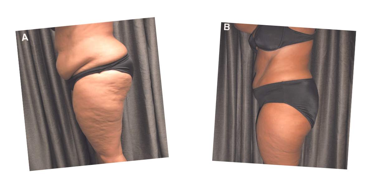 Hips and thighs before and after a course of Emerald Laser sessions