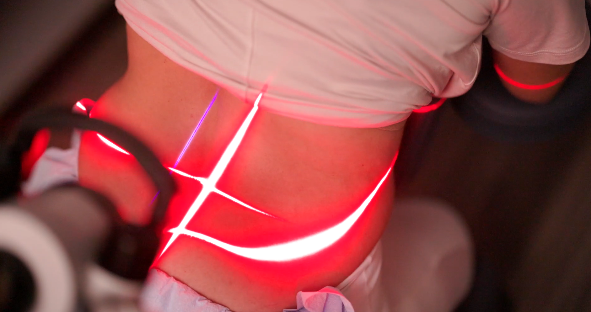 FX 405 laser positioned over a patient's lower back during a pain treatment session