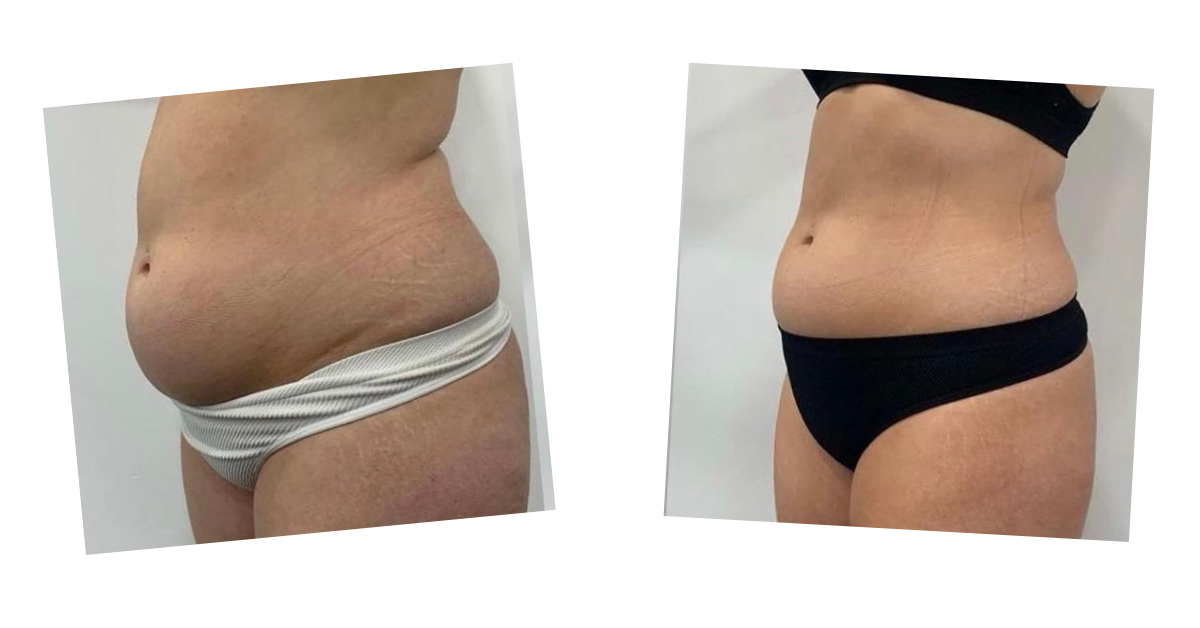Abdomen — oblique view — before and after Emerald Laser treatment