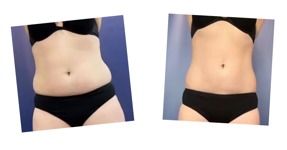 Waist and abdomen — before and after Emerald Laser treatment