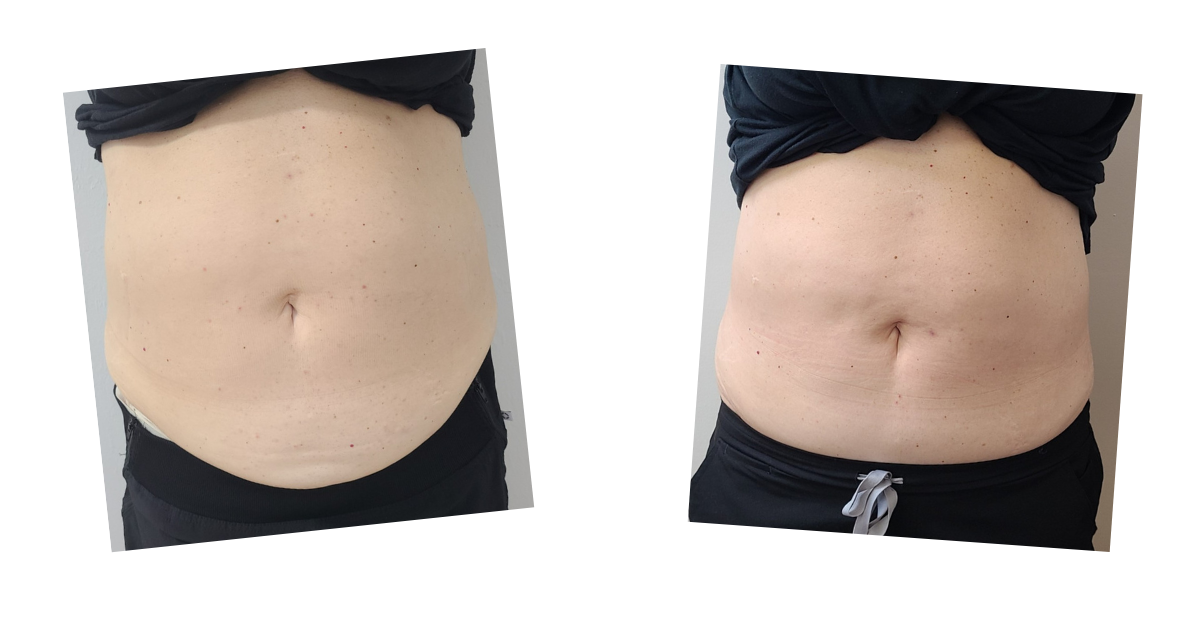 Abdomen — anterior view — before and after Emerald Laser treatment