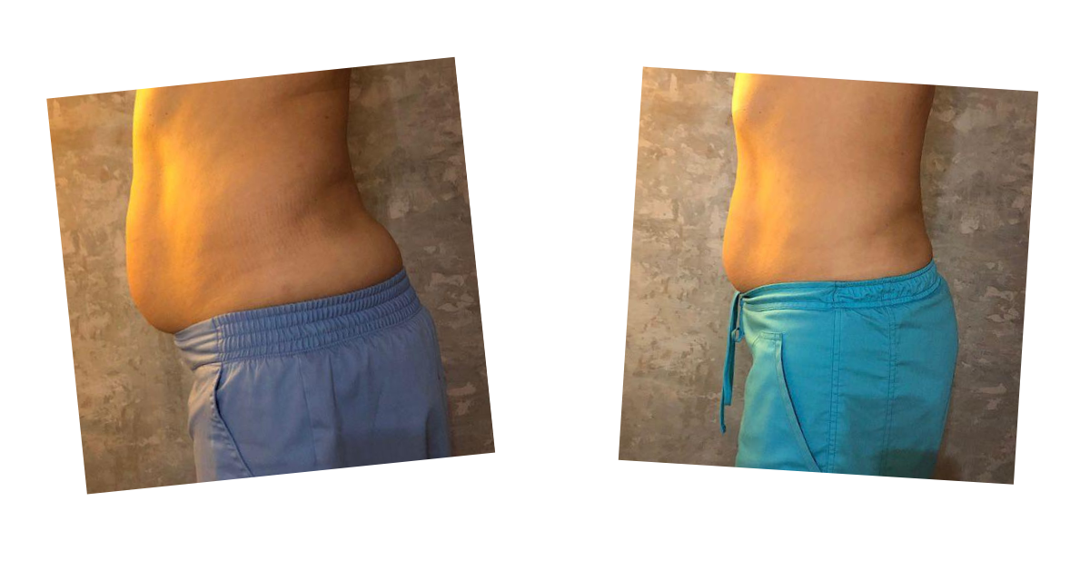 Abdomen — lateral view — before and after Emerald Laser treatment